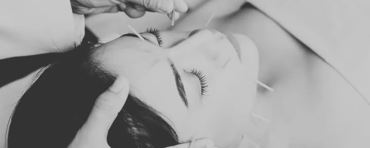 Acupuntura facial