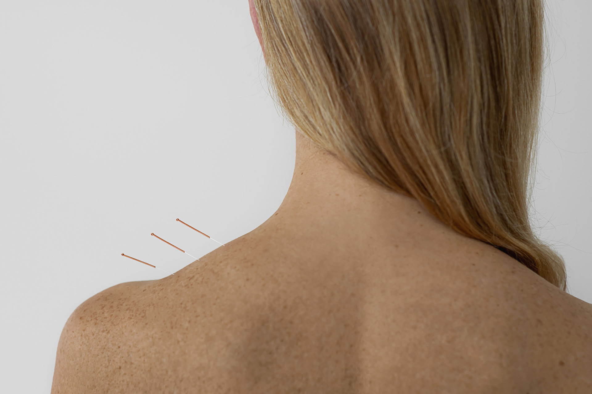 Acupuntura