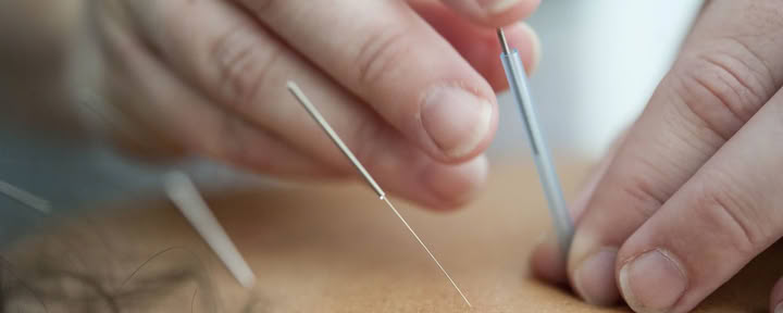 $95 Primera visita - Sesión de acupuntura