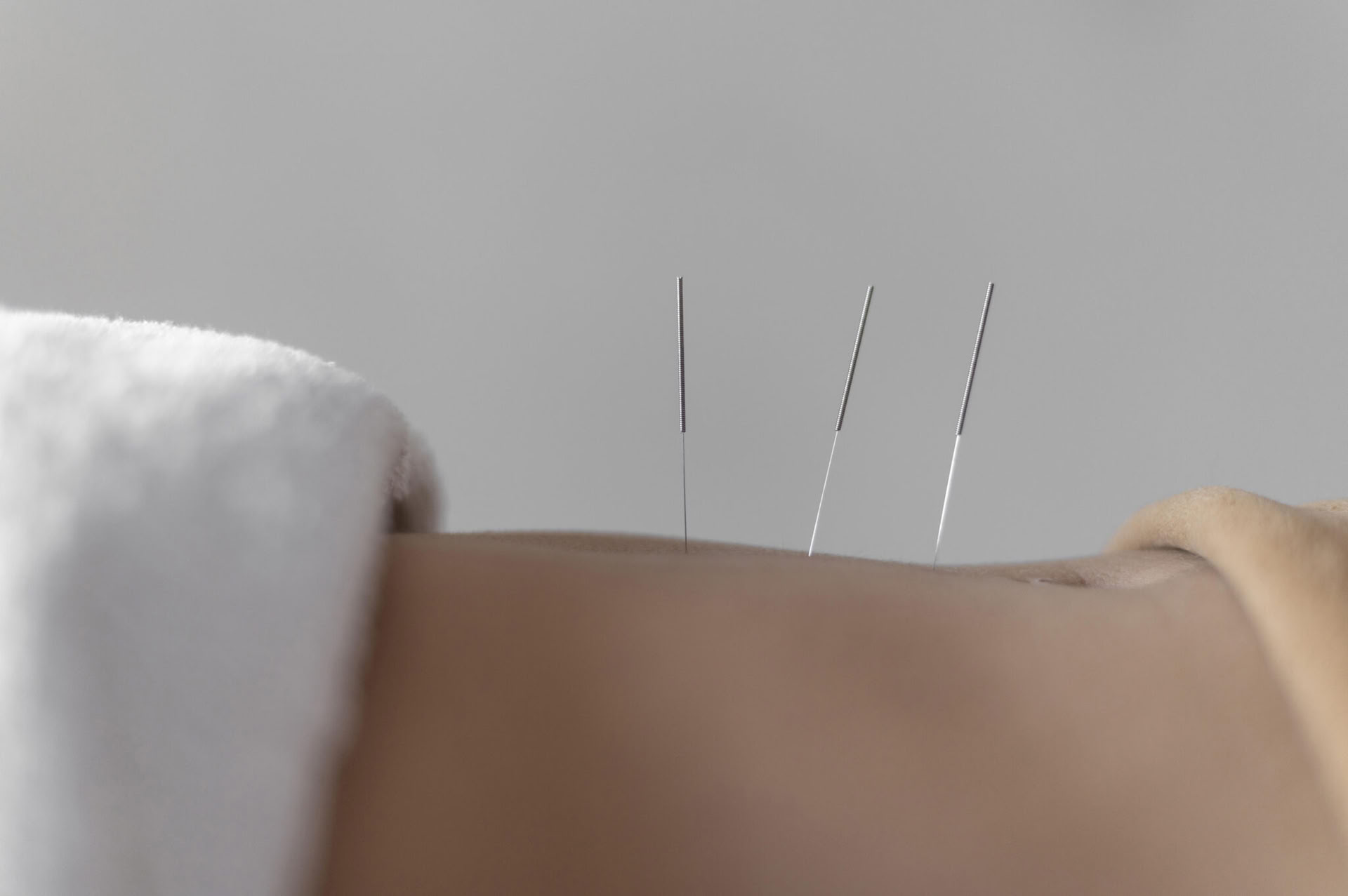 Acupuntura