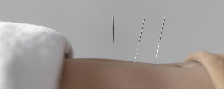 Acupuntura